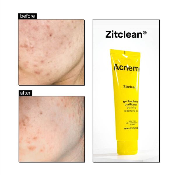 Acnemy Zitclean150 мл ЦБ-00032256 фото